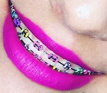 Frenos con ligas de Colores