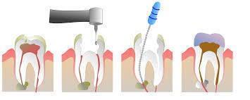 Endodoncia