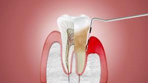 Periodoncia
