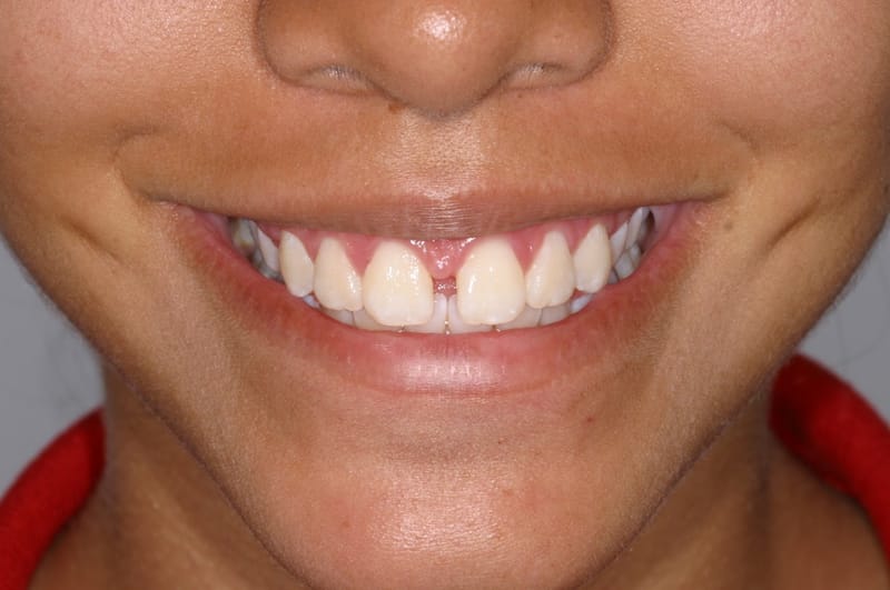 Si tengo un DIASTEMA