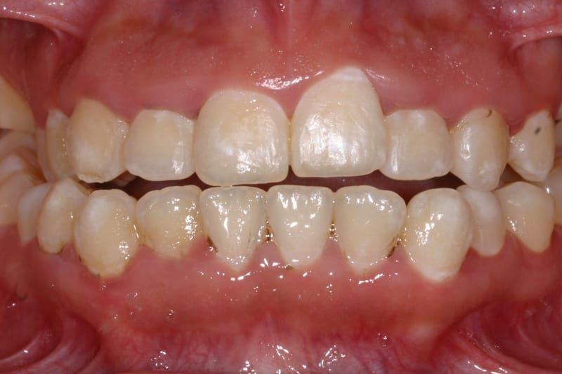 Si tengo la MORDIDA ABIERTA