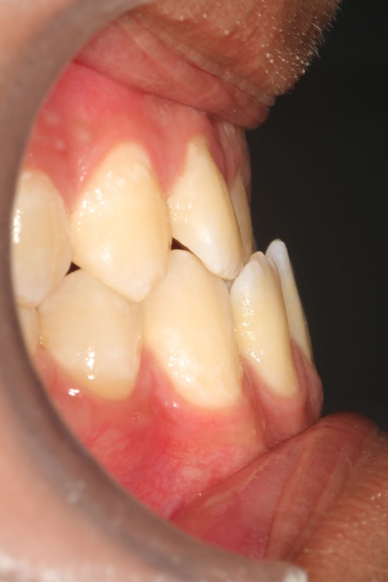 si tengo la MORDIDA CRUZADA