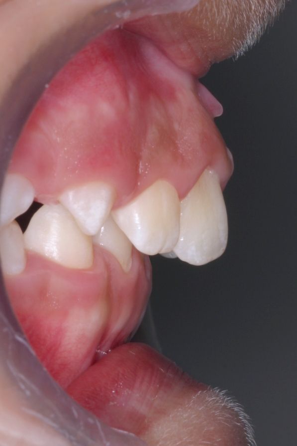 Si tengo MORDIDA PROFUNDA