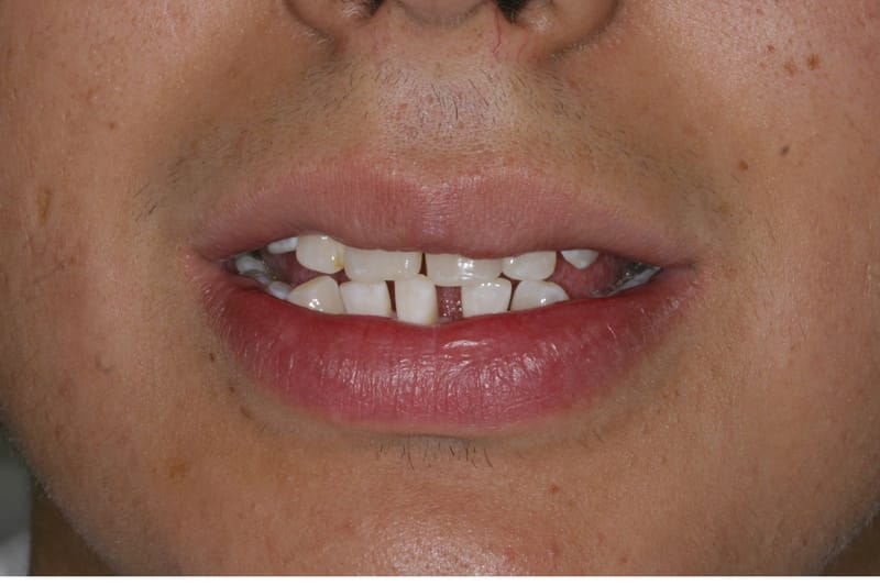 Si tengo SEPARACIONES en mis dientes