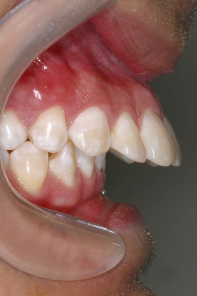 Si tengo DIENTES SALIDOS