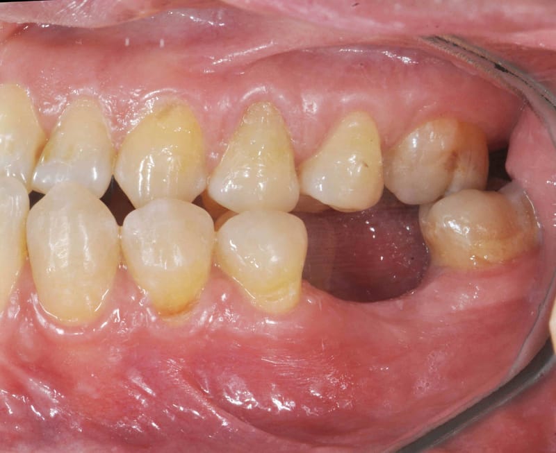 si tengo MORDIDA TRAUMATICA