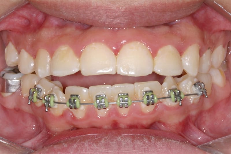 Si tengo un TRATAMIENTO MAL HECHO