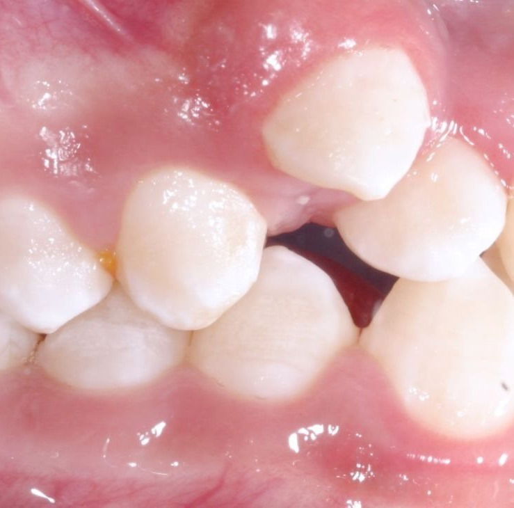 Si tengo los COLMILLOS ARRIBA