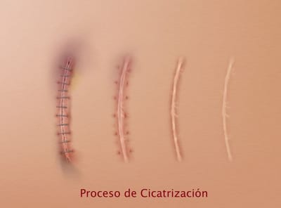 CICATRIZACIÓN DE HERIDAS