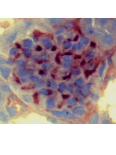 Doença de Chagas image