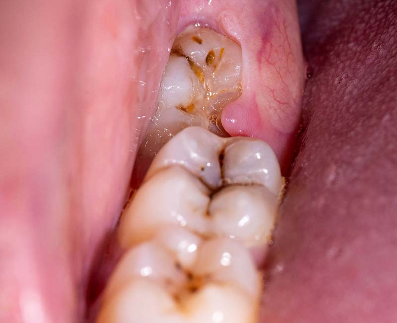 Wisdom Tooth Pain