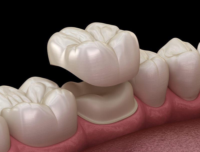 Dental Crowns