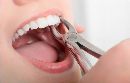 Emergency Tooth Extraction