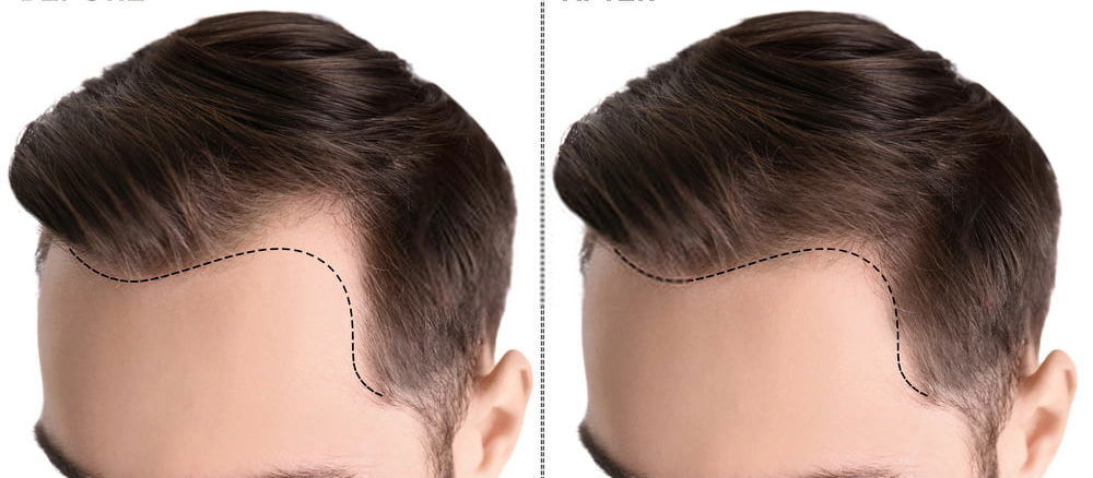 كل ما تريد معرفتة عن عملية زراعة الشعر