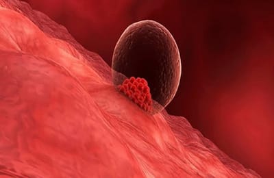 Mất Ngủ Sau Chuyển Phôi: Nguyên Nhân Và Cách Khắc Phục