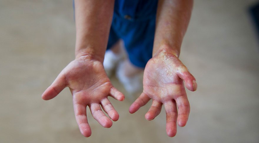 Skleroderma hastası minik İklim sağlığına kavuşmak istiyor