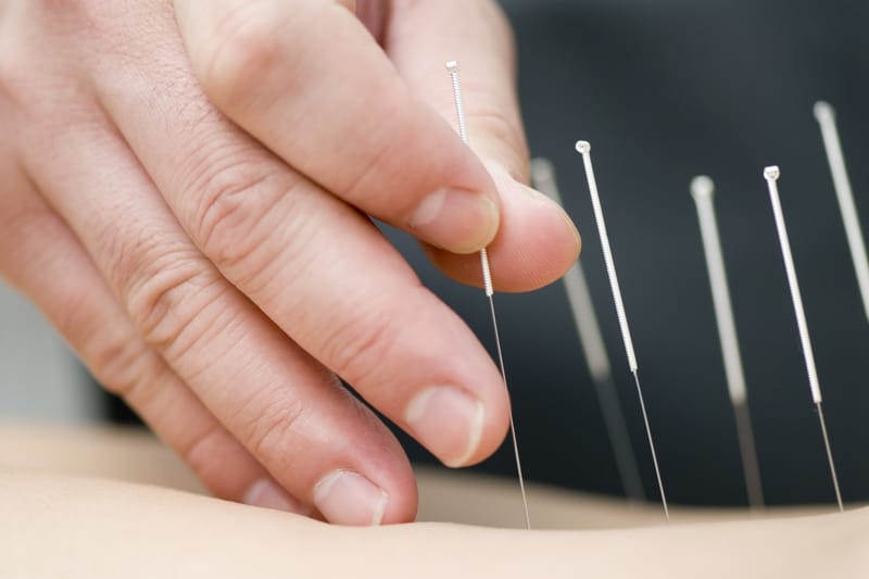 Medical Acupuncture