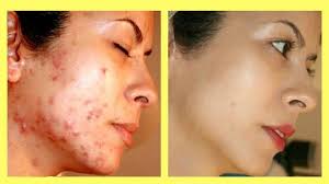 Acne scars: A quick look at home remedies and modern-day treatments.