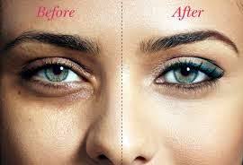 Dark Circles - What is Causing You to Have Them?