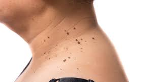 5 Ways For Best Natural Warts Treatment