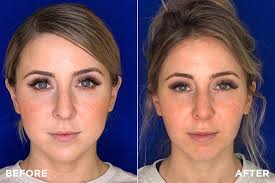 Facial Fat Removal - Can it Be Done With Liposuction?