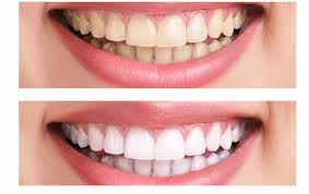 Teeth Whitening Strips - Which Are The Best And Do They Really Whiten Discolored Teeth?