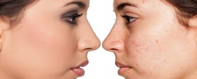 Acne Treatments Review