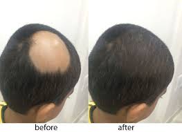 Alopecia Areata May Require Change in Diet