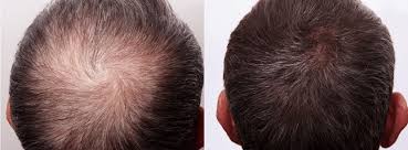 PRP Procedure for Hair Restoration: A Promising New Way to Regrow Your Hair