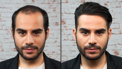 3 Things That Will Help You To Find The Best Hair Transplant Clinic