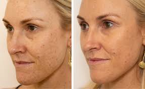 Facial Pigmentation Treatment - Get Rid Of Blemishes And Regain Smooth Even-Toned Skin