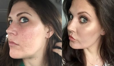 FRX Fractional CO2 Resurfacing