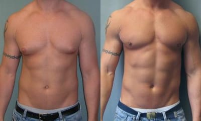 GYNECOMASTIA SURGERY GUIDE