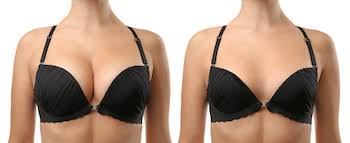 Breast reduction surgery