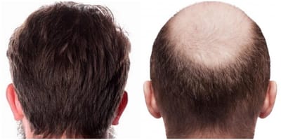 Is a hair transplant worth the cost?