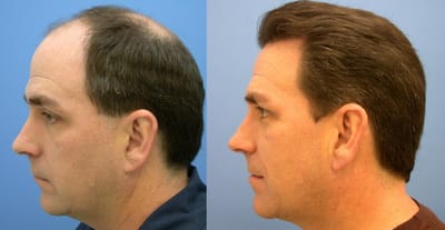 Hair Implants Q&A - Is Hair Implant Surgery Safe, Effective, and Affordable?