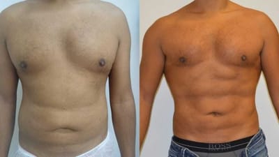 What Can I Expect After Vaser Liposculpture?