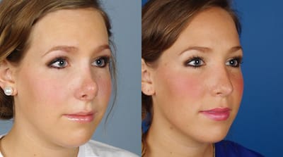 4 Common Types of Rhinoplasty
