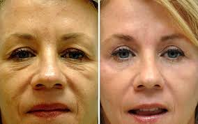 A Detailed Look At Eyelid Surgery