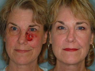 Find a Plastic Surgeon For Facial Reconstruction