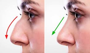 Benefits From a Septoplasty Surgery
