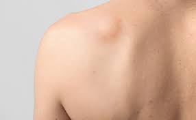 Why LipoDissolve May Not Be the Best Treatment for Lipomas