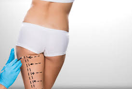 Thigh Lift - Choosing the Right Surgeon is the Key