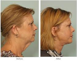 Neck Lifts