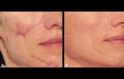 How to Improve Your Facelift Scars