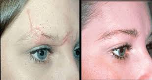 Acne Scar Cure Tips to Remember