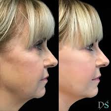Facelift Surgery