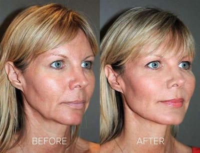 A Stronger Profile & Firmer, Younger Looking Skin With PDO Thread Lift Treatment