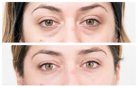 Is There A Natural Method To Remove Under Eye Bags?