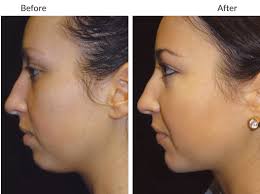 Chin Augmentation Can Make a Strong Statement